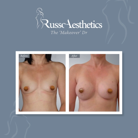 https://drmariorusso.com/wp-content/uploads/2023/10/Breast-Augmentation-06.webp