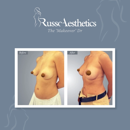 https://drmariorusso.com/wp-content/uploads/2023/10/Breast-Augmentation-08.webp