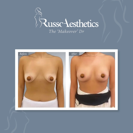 https://drmariorusso.com/wp-content/uploads/2023/10/Breast-Augmentation-09.webp