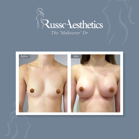 https://drmariorusso.com/wp-content/uploads/2023/10/Breast-Augmentation-10.webp