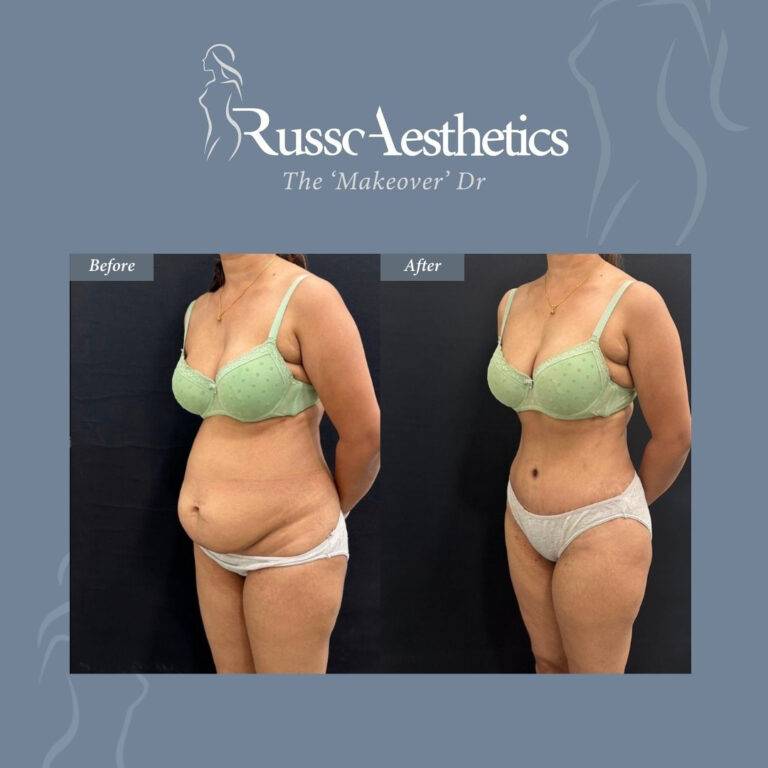 Before and after body transformation after mommy makeover surgery