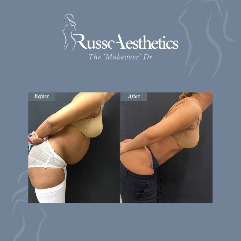 extended tummy tuck before and after image