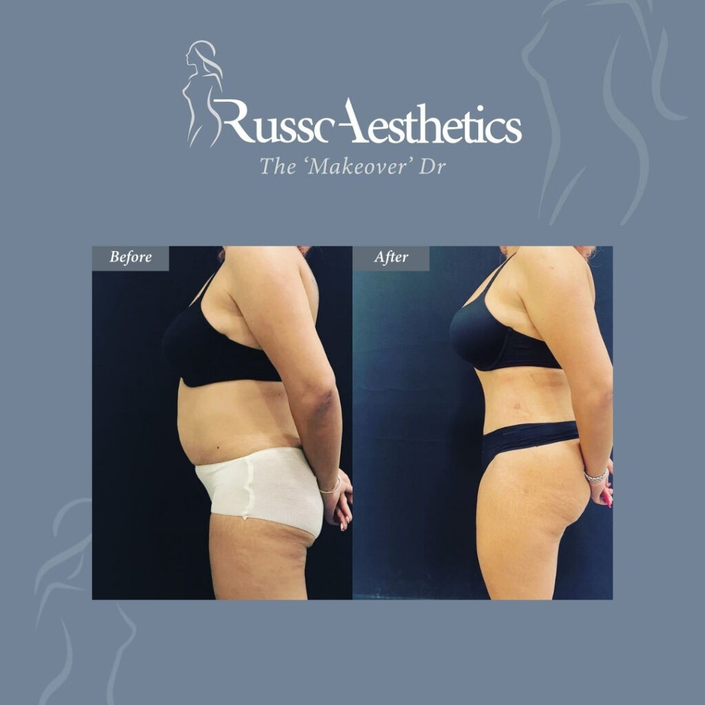 patients before and after image after tummy tuck surgery