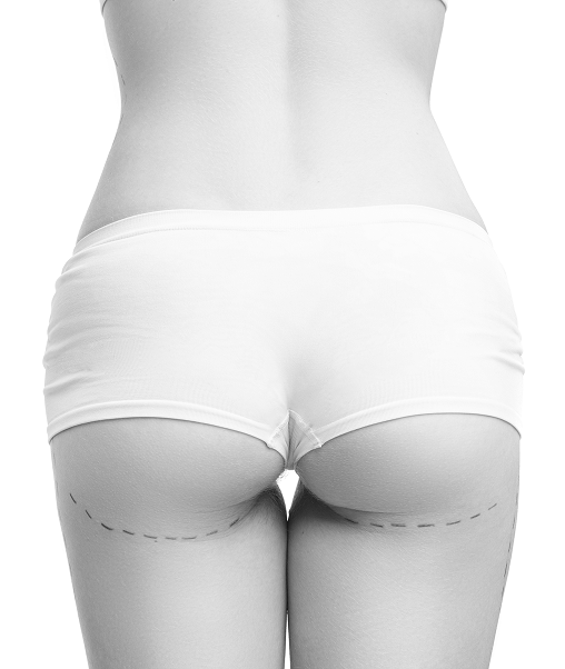 Brazilian Butt Lift Dubai