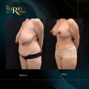 Before and after body transformation and breast reduction surgery