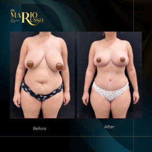 Before and after body transformation and breast reduction and tummy tuck surgery