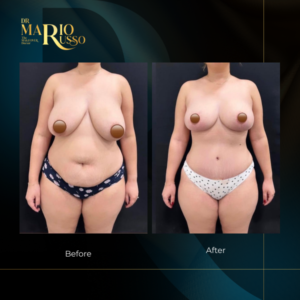 Before and after body transformation and breast reduction and tummy tuck surgery
