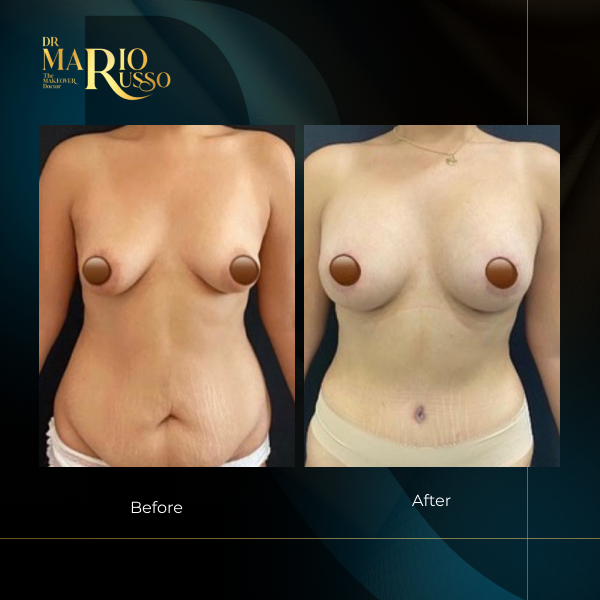 breast and aerola reconstruction