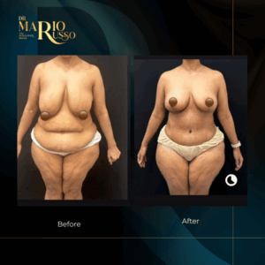 before and after breast reduction surgery