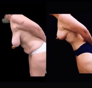 Before and after side view of tummy tuck and breast lift surgery results