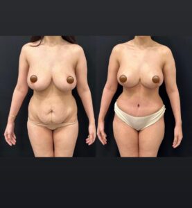 Front view before and after tummy tuck with breast enhancement results