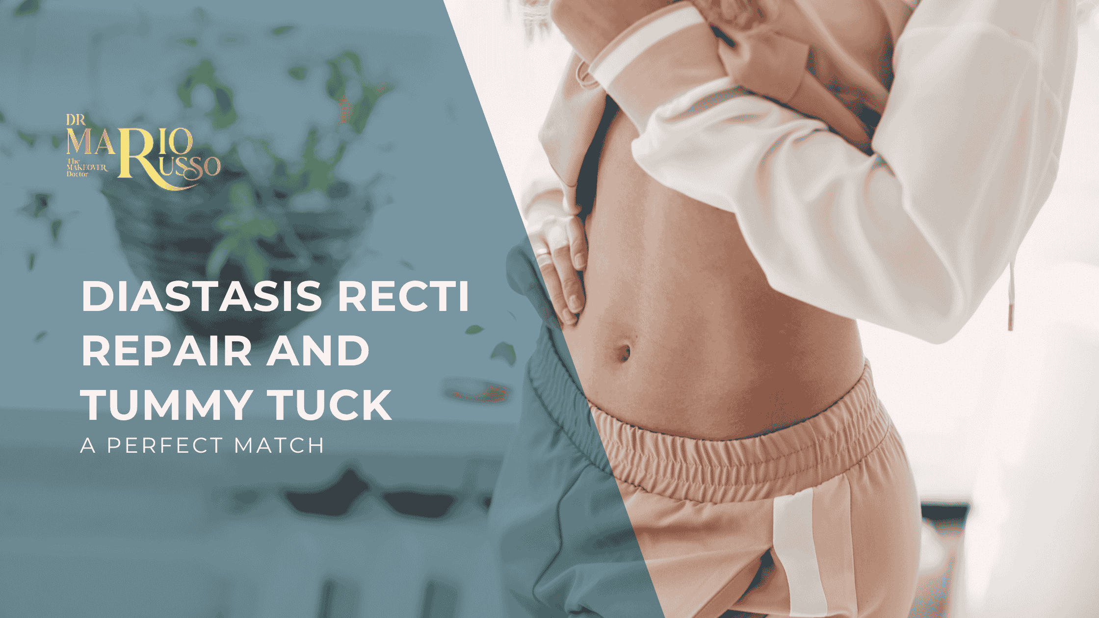 Diastasis Recti Repair and Tummy Tuck together