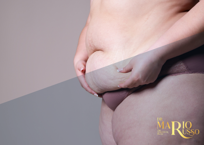 مدة الشفاء من عملية شد البطن في دبي